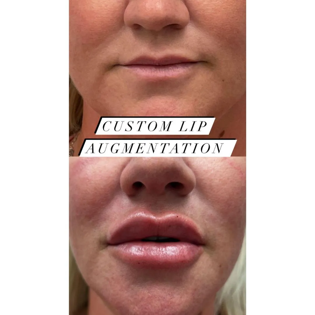 Custom Lip Augmentation