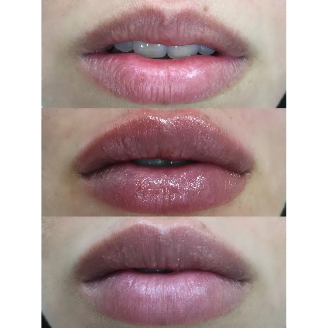 Custom Lip Augmentation