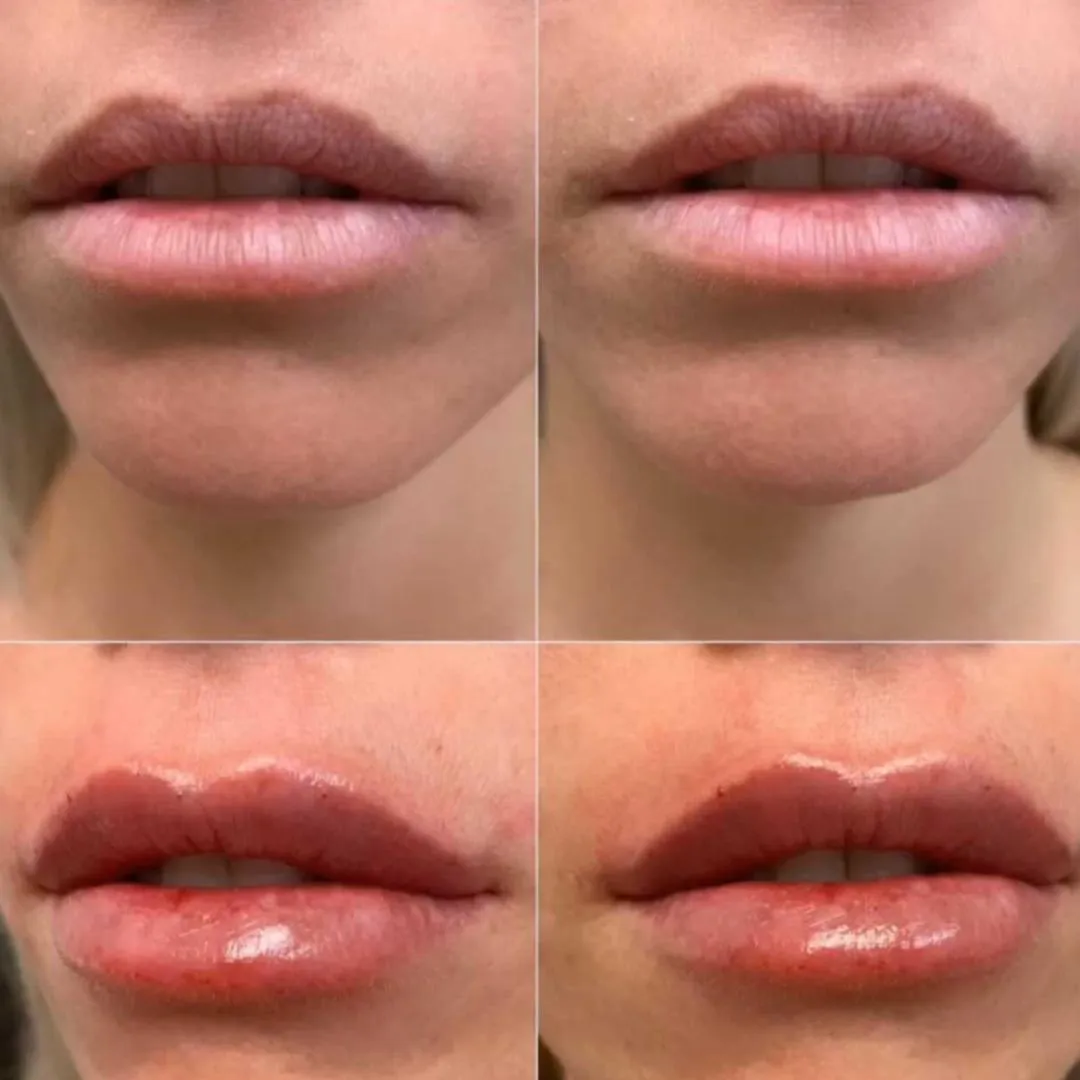 Custom Lip Augmentation