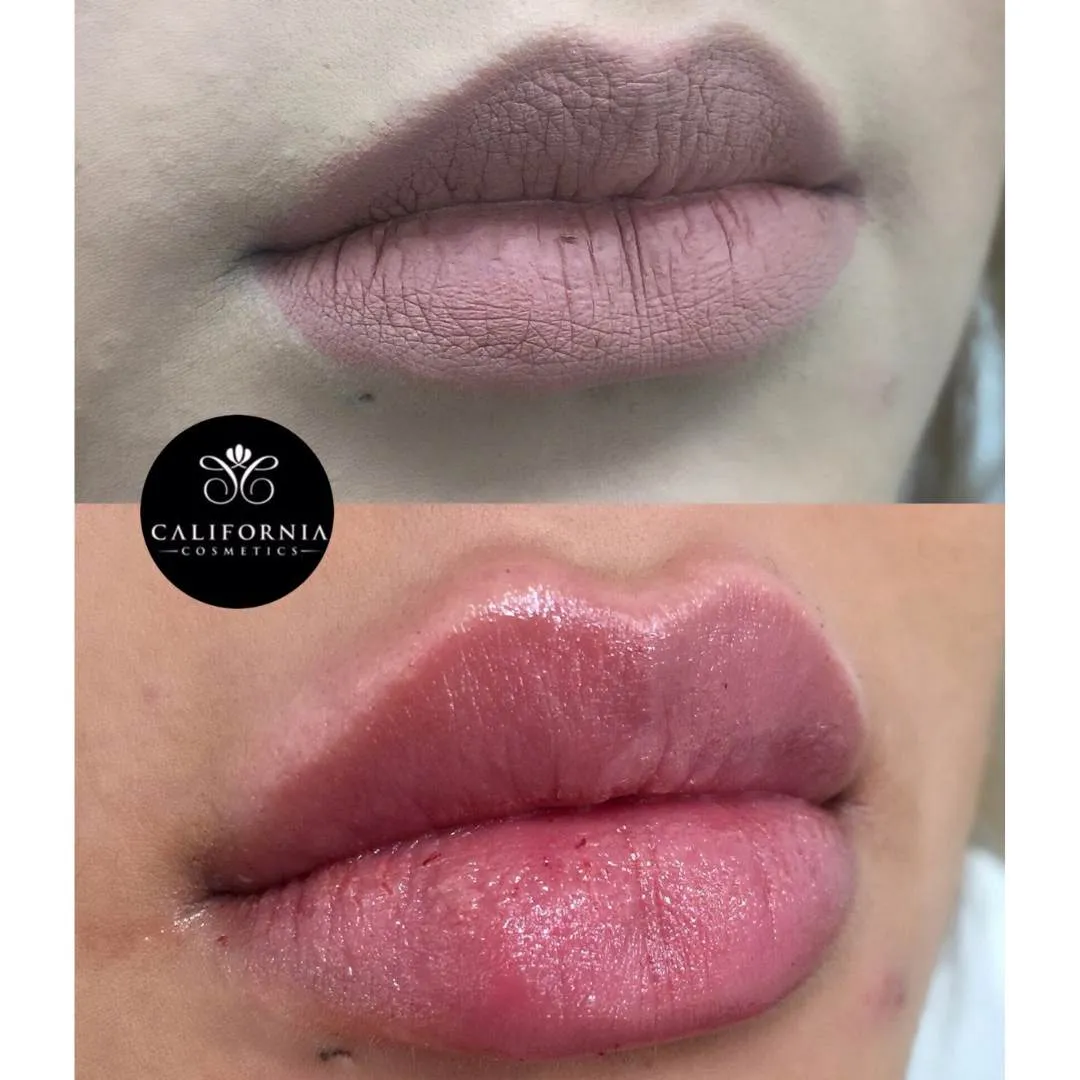 Custom Lip Augmentation