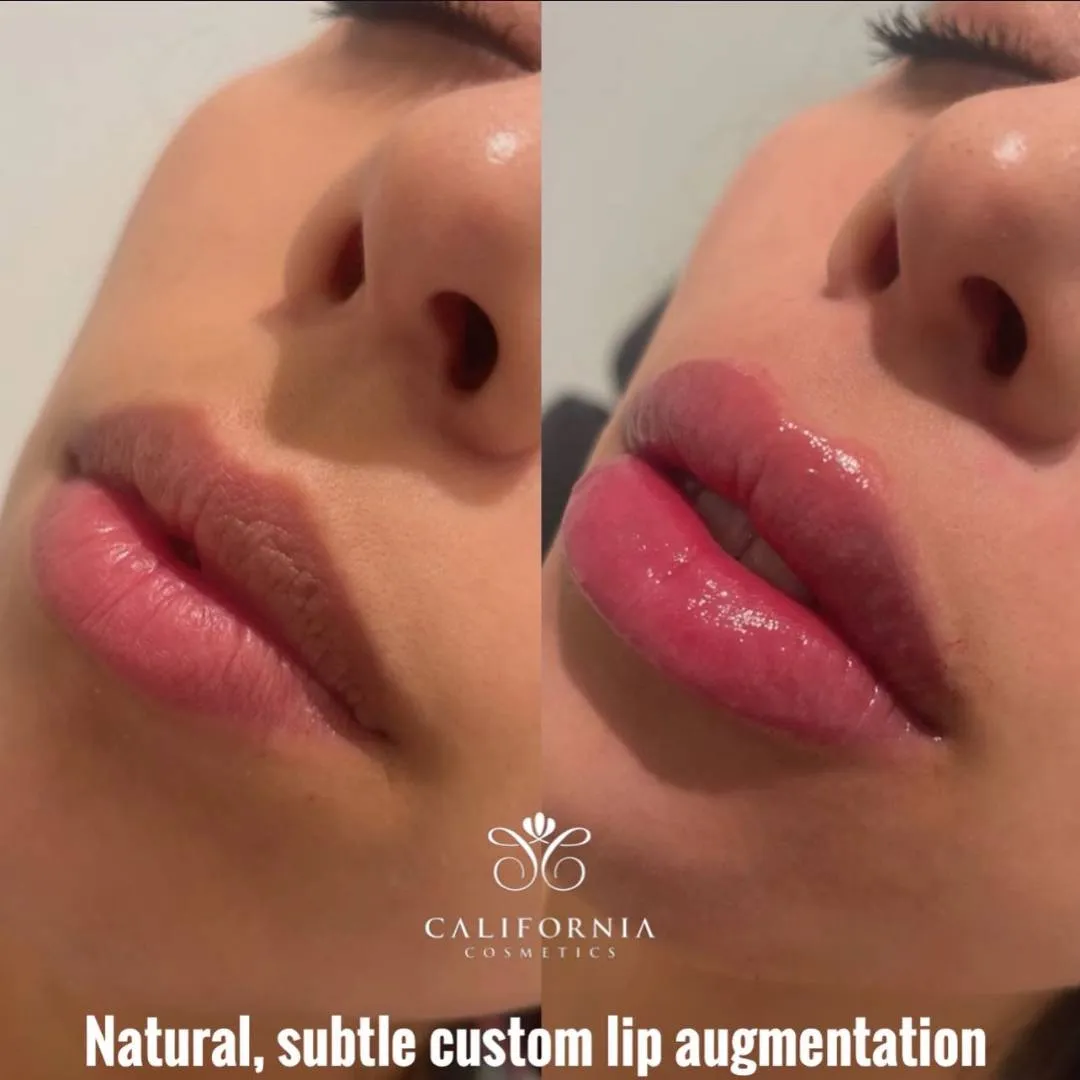 Custom Lip Augmentation