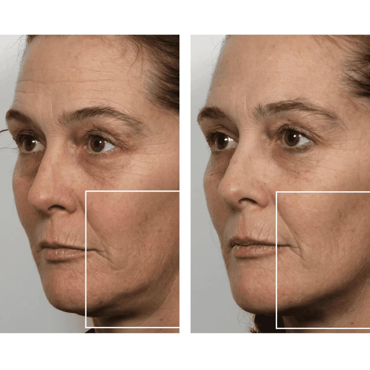 NuFACE Microcurrent Facial Toning Device
